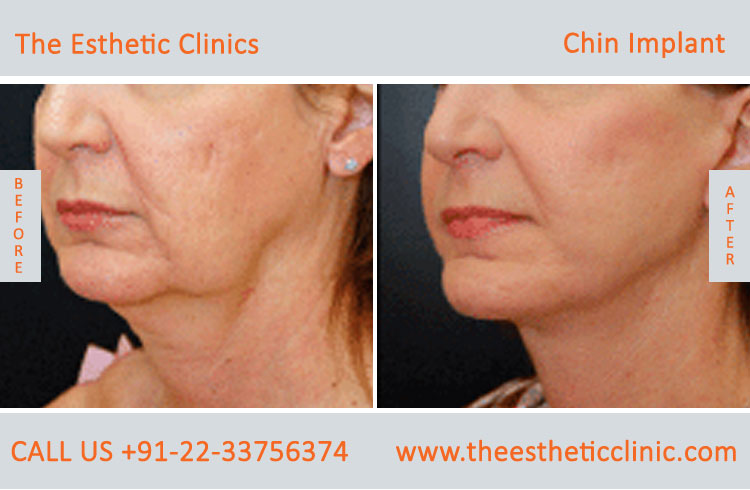 chin Augmentation, chin Implants surgery before after photos in mumbai india (1)